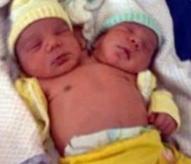 巴西双头婴儿意外诞生 两个头颅共用一个身体(依旧存活)