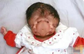澳大利亚怪婴之谜 女子产下双面婴儿(两张脸/一个身体)
